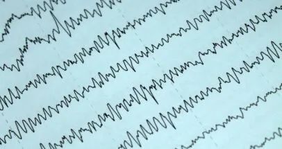 科学家利用 AI 和快速反应脑电图提高谵妄检测能力